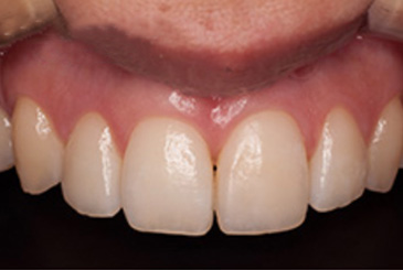 歯の色の改善治療後