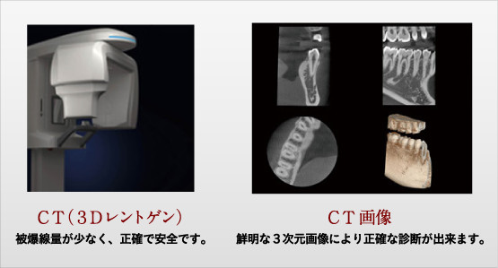 CT（3Dスキャン）とCT画像