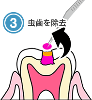 虫歯を除去