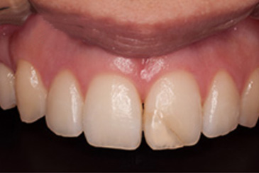 歯の色の改善治療前