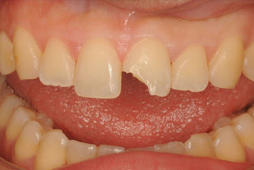 歯の形態の改善治療前