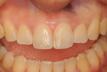 歯の形態の改善治療後