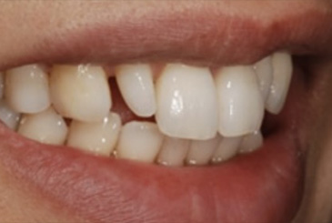 歯の形態の改善治療前2