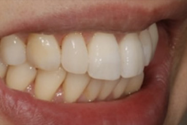 歯の形態の改善治療後2