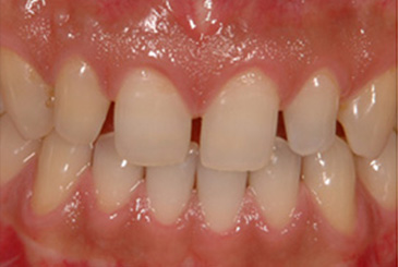 すきっ歯の改善治療前