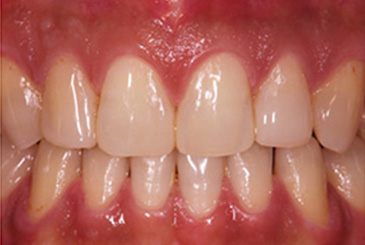 すきっ歯の改善治療後