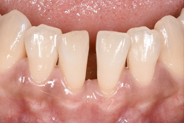 すきっ歯の改善治療前2