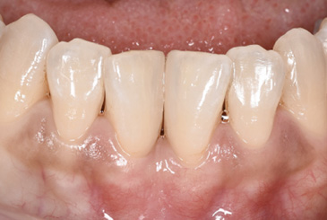 すきっ歯の改善治療後2