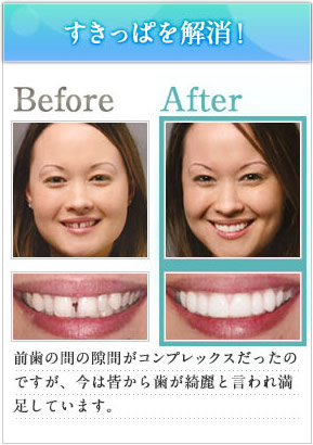 すきっぱを解消！前歯の間の隙間がコンプレックスだったのですが、今は皆から綺麗といわれ満足しています。