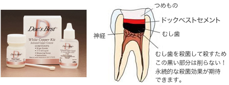 むし歯を殺菌して殺すため、この黒い部分は削らない！永続的な殺菌効果が期待できます。